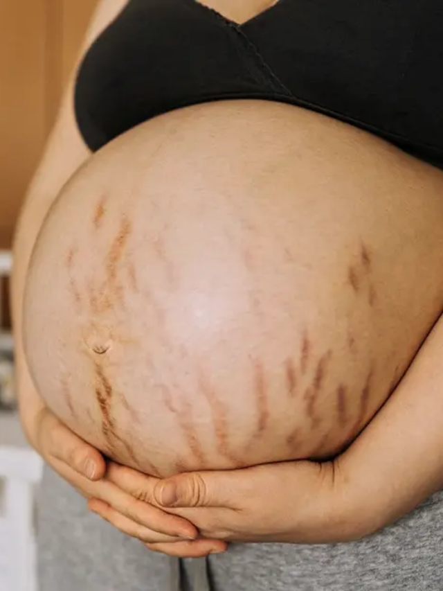 How to Prevent Stretch Marks During Pregnancy, According to Experts